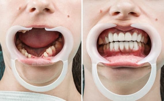 Impianti dentali quale è stato installato nella clinica dentale Grand Turismo Dentale di Chișinău