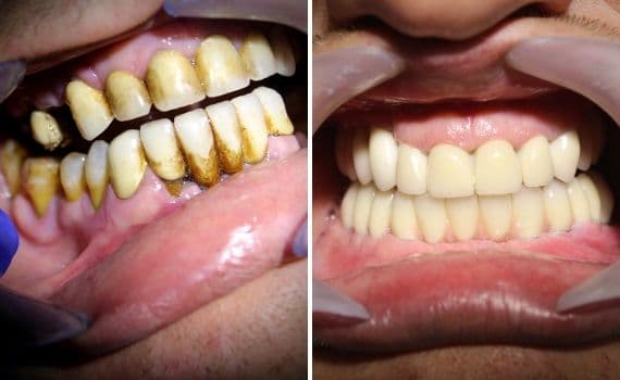 Sui denti del paziente sono state inserite una serie di corone dentali in modo da correggere ed allineare in modo uniforme la struttura dei denti nella clinica dentale Grand Turismo Dentale di Chișinău