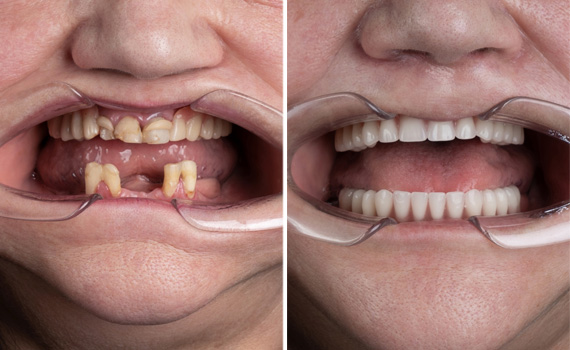 Le faccette in ceramica nella clinica dentale Grand Turismo Dentale di Chisinau sono le più utilizzate grazie alla resistenza ottimale del materiale, e al fatto non trascurabile che si tratta di restauri adesivi minimamente invasivi.