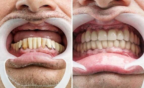 Il paziente e’ stato sottoposto all’inserimento di impianti dentali nella clinica dentale Grand Turismo Dentale di Chișinău. Si tratta di una radice artificiale che viene ancorata all’osso con la funzione di sostegno per la corona che andrà a sostituire il dente mancante.