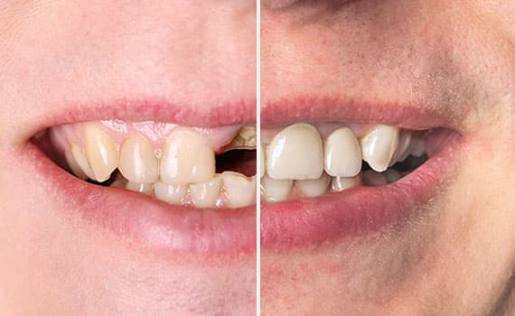 Terapia dell'igiene. Il nostro trattamento di rimozione delle macchie ha rimosso anni di scolorimento da tè, caffè e tabacco.