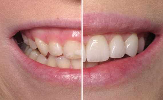 Le faccette in ceramica  nella clinica dentale Grand Turismo Dentale di Chisinau sono le più utilizzate grazie alla resistenza ottimale del materiale, e al fatto non trascurabile che si tratta di restauri adesivi minimamente invasivi.