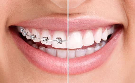 I denti di questi pazienti sono stati corretti e raddrizzati con allineatori chiari quasi invisibili. Grand Turismo Dentale