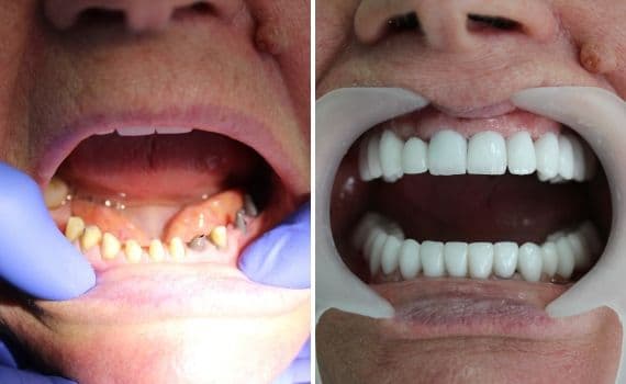 Il paziente e’ stato sottoposto all’inserimento di impianti dentali nella clinica dentistica Grand Turismo in Moldavia