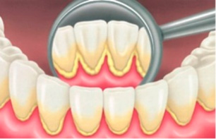 Durante la seduta di igiene professionale nella clinica dentale Grand Turismo Dentale in Moldavia si effettua la rimozione del tartaro con metodo manuale o a ultrasuoni, e successivamente si completa la pulizia dei denti con la lucidatura delle superfici dentali.