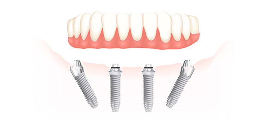 L’implantologia All on four è una tecnica odontoiatrica moderna che consente di riabilitare intere arcate dentali danneggiate e o molto compromesse, o addirittura prive di denti.Approfitta dell'offerta a prezzo ridotto per questo impianto nella clinica dentale Grand Turismo Dentale