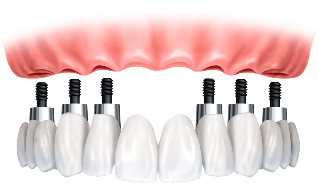 Il on six è una tecnica implantologica di nuova generazione, che prevede l’inserimento di una protesi dentaria, a totale sostituzione dei denti naturali mancanti, fissandola su sei perni..Approfitta dell'offerta a prezzo ridotto per questo impianto nella clinica dentale Grand Turismo Dentale