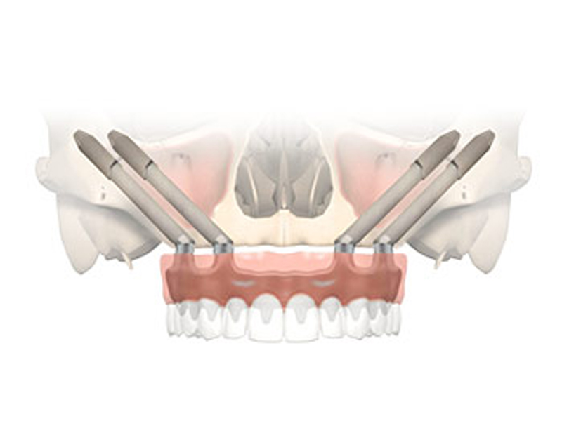 Offerta Impianti Zigomatici con il prezzo di 3 790 € include le seguenti opere e materiali: 2 impianti zigomatici; 2 abutments zigomatici (connessioni protesiche); 12 denti provvisori fisii a carico immediato (denti in resina); Anestesia generale