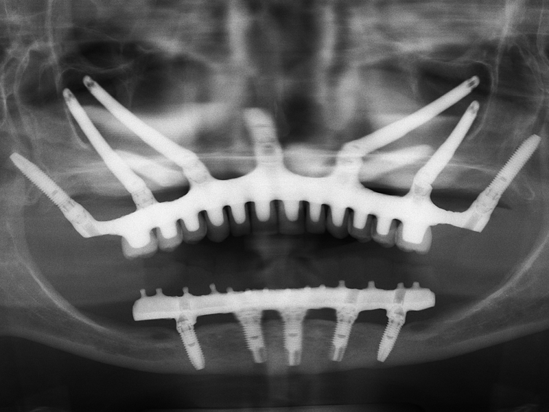 Offerta Impianti Zigomatici con il prezzo di 3 790 € include le seguenti opere e materiali: 2 impianti zigomatici; 2 abutments zigomatici (connessioni protesiche); 12 denti provvisori fisii a carico immediato (denti in resina); Anestesia generale